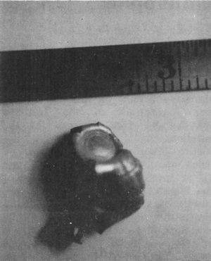 Photographie de la fameuse balle tirée par Carl Higdon le 25 octobre 1974 qui est sortie au ralenti de son fusil, et qui a été comme retournée sur elle-même.